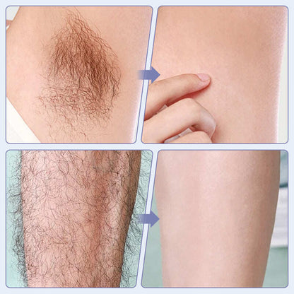 Laser IPL Hair Removal Device With Ice-Cooling Contact